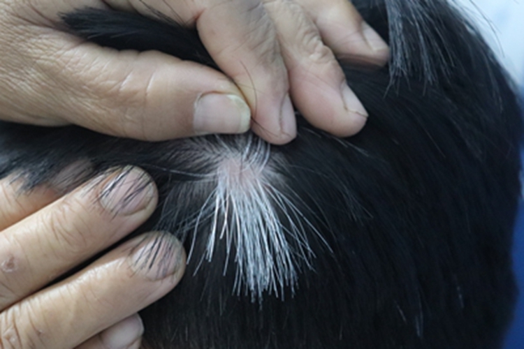 稳定期节段型白癜风头皮白斑图 稳定期节段型白癜风头皮白斑图