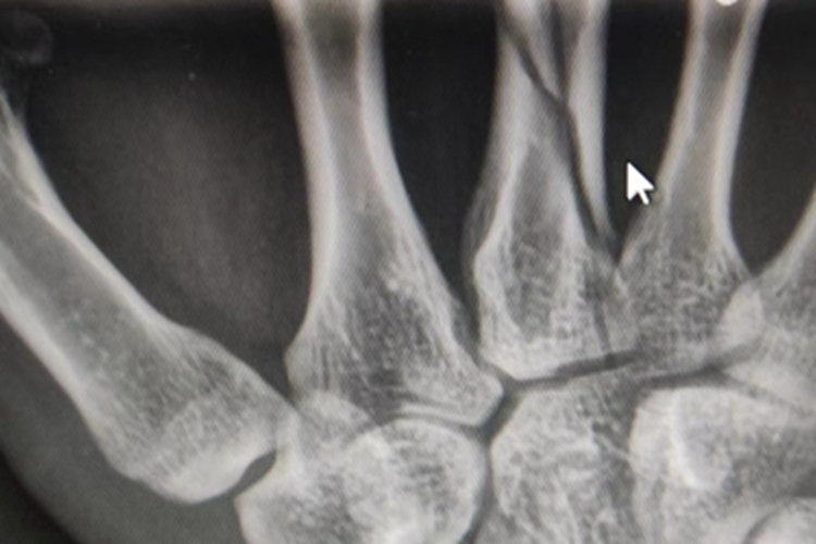骨折手掌的骨头有裂纹图 骨折手掌的骨头有裂纹图