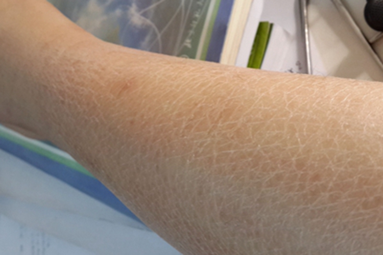 无汗症小腿症状图 无汗症小腿症状图