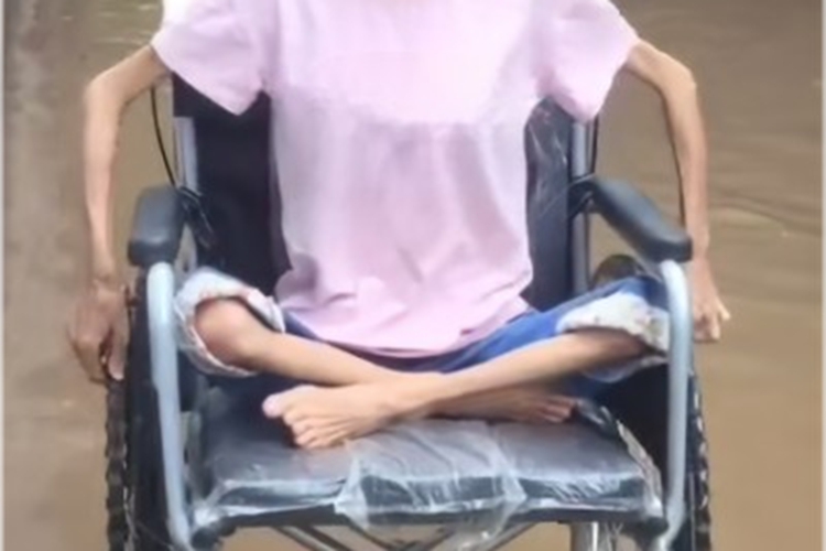 严重的肌肉萎缩症图