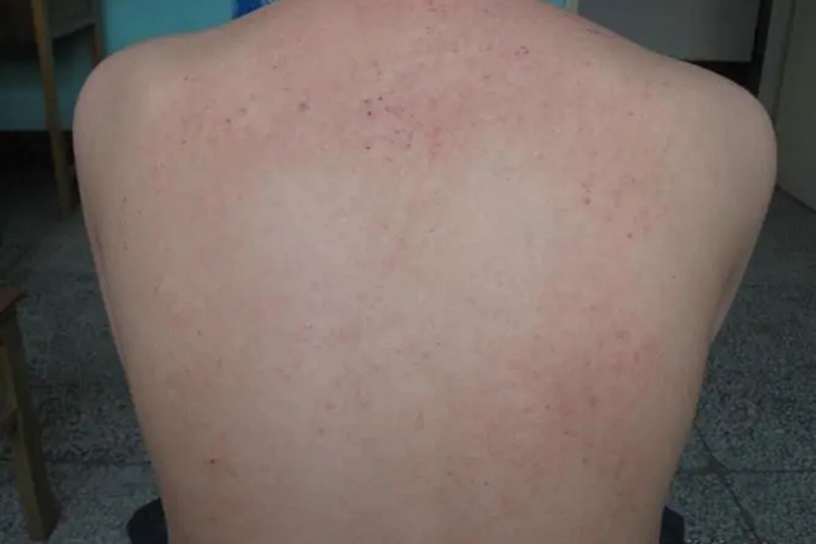 青年成人期特应性皮炎背部红斑图