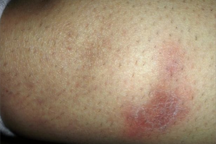 嗜酸性脂膜炎大腿症状图