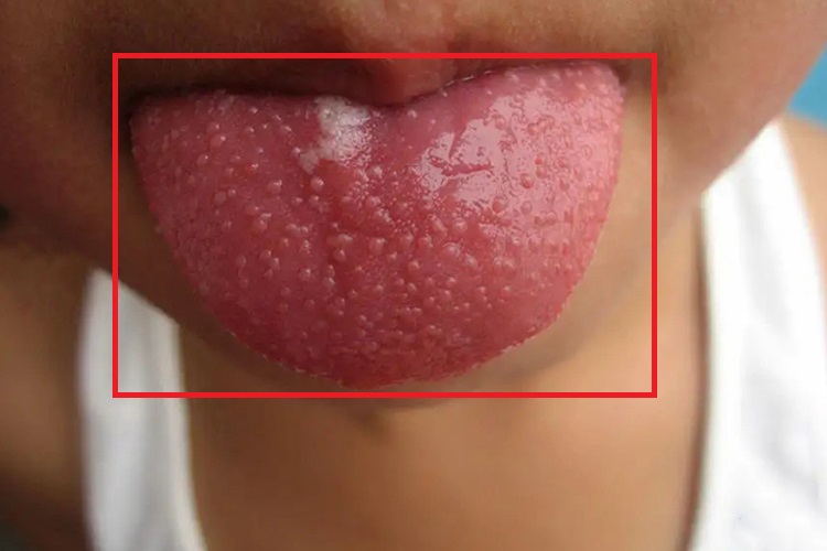 菌状乳头炎舌背乳头突起图 菌状乳头炎舌背乳头突起图