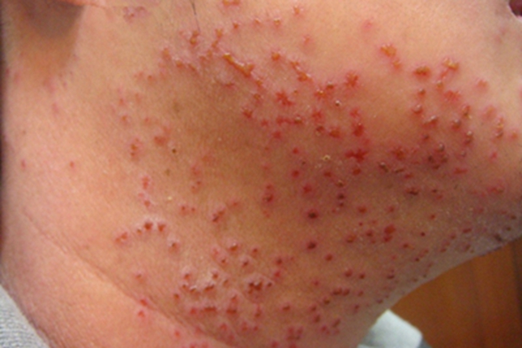 水痘下巴密集水疱顶端结痂图 水痘下巴密集水疱顶端结痂图