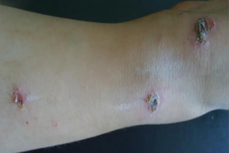 深脓疱疮胳膊上结痂图 深脓疱疮胳膊上结痂图