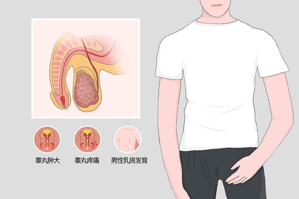 睾丸癌 早期图片