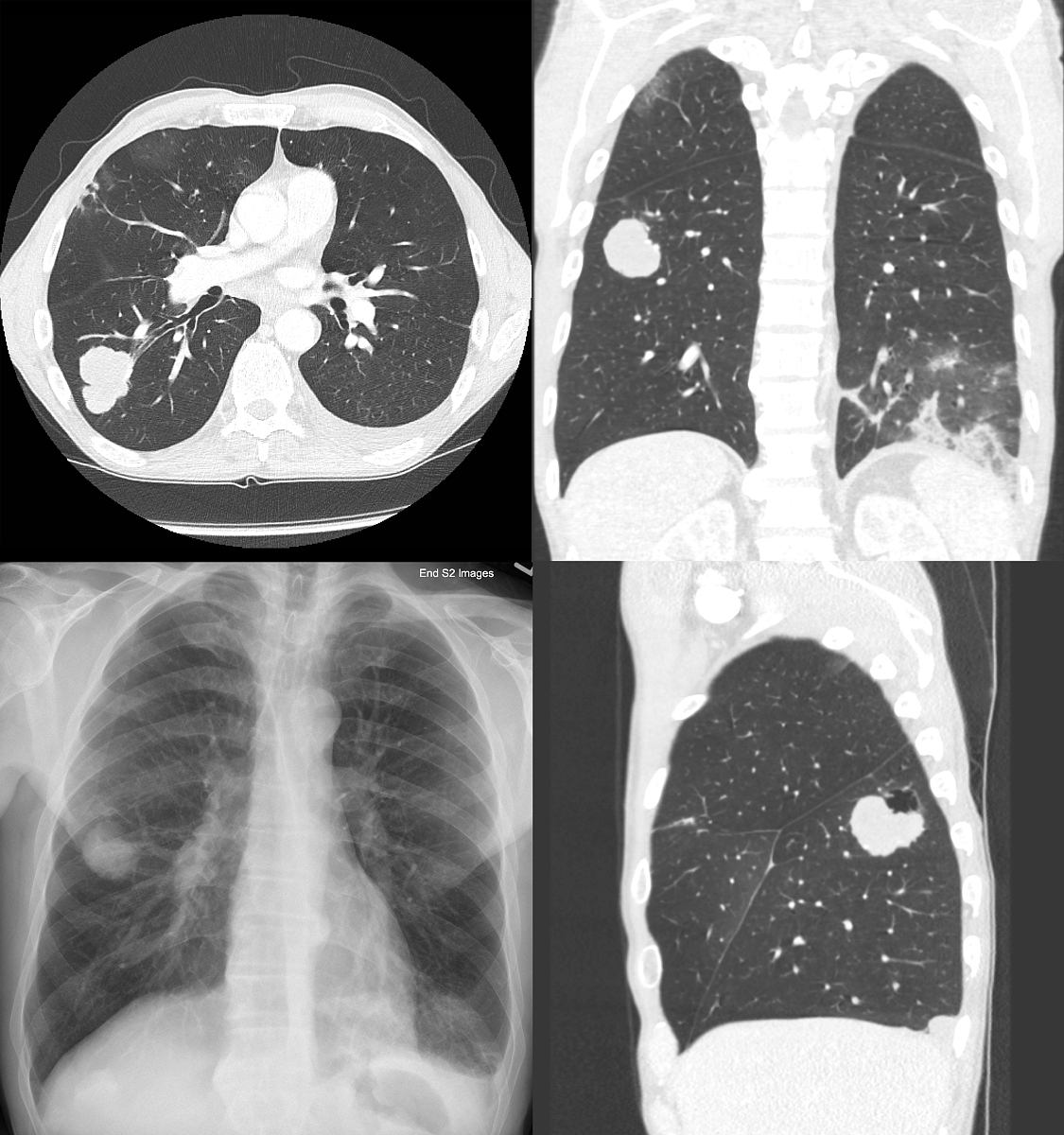 病例137 肺泡细胞癌-特种医学-医学
