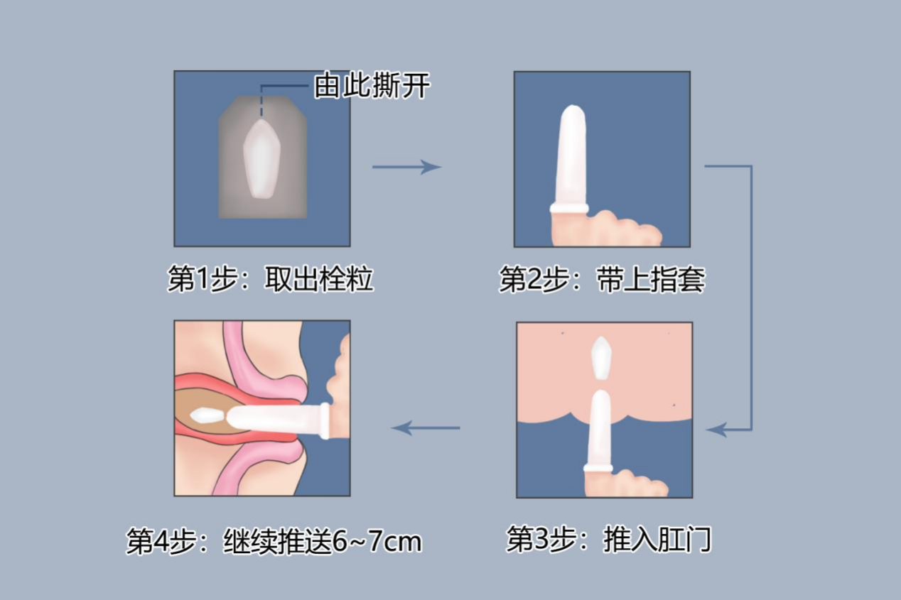 妇科给药器使用示意图图片