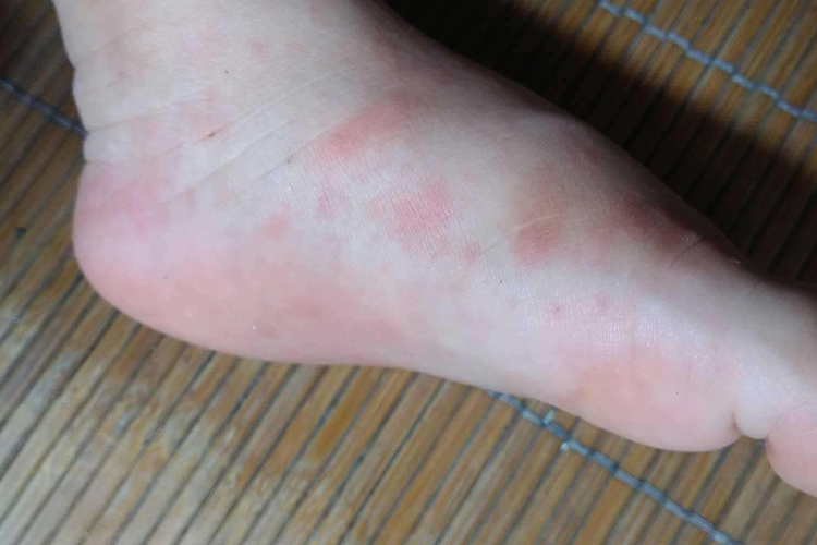 接触性皮炎图