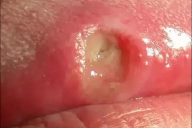 口腔黏膜结核性溃疡舌侧症状图 口腔黏膜结核性溃疡舌侧症状图