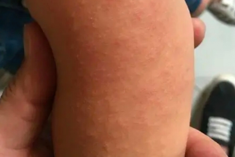 亚急性接触性皮炎早期皮损图