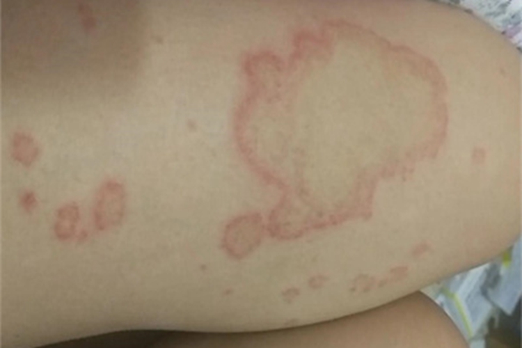 毛细血管扩张性环状紫癜红斑图 毛细血管扩张性环状紫癜红斑图