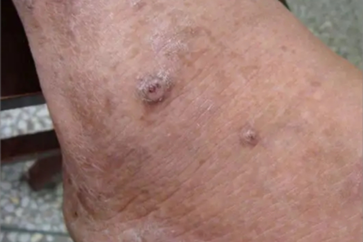 砷角化病脚背脱屑图