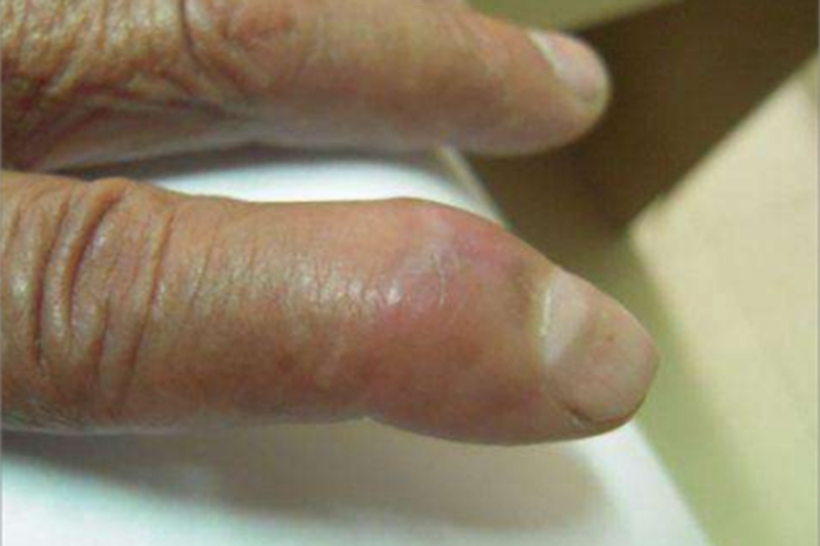 混合性结缔组织病手指僵硬图