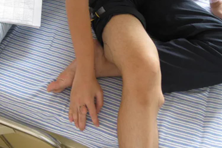 胫骨上端骨软骨瘤图 胫骨上端骨软骨瘤图