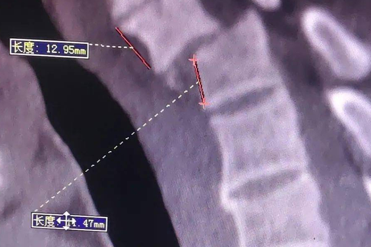 颈椎第七节滑脱检查图 颈椎第七节滑脱检查图