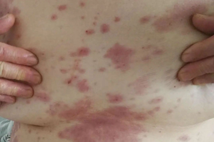 轻型多形红斑型药疹胸部症状图 轻型多形红斑型药疹胸部症状图