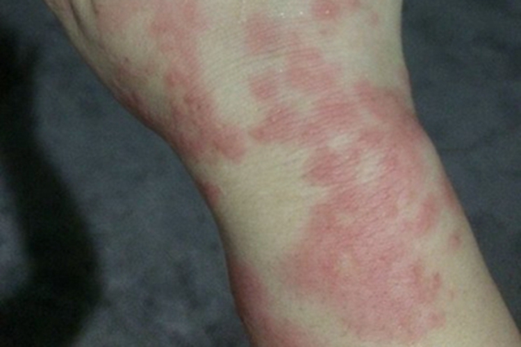 胆碱能性荨麻疹胳膊风团图 胆碱能性荨麻疹胳膊风团图