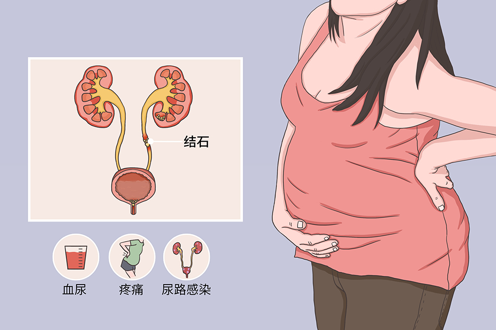 尿路结石疼痛位置图片