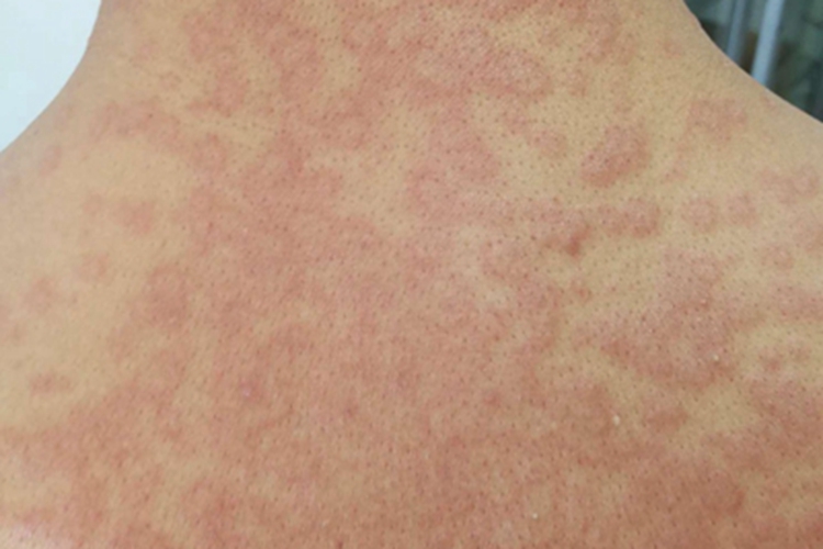 丘疹型轻型多形红斑后背红斑图 丘疹型轻型多形红斑后背红斑图