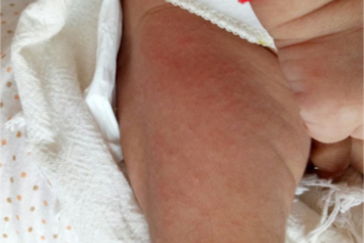 小儿丘疹性肢端皮炎丘疹图