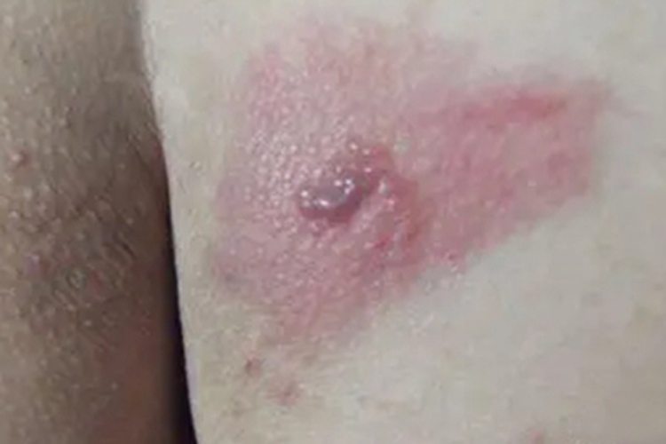 肛周接触性皮炎肛周水疱图