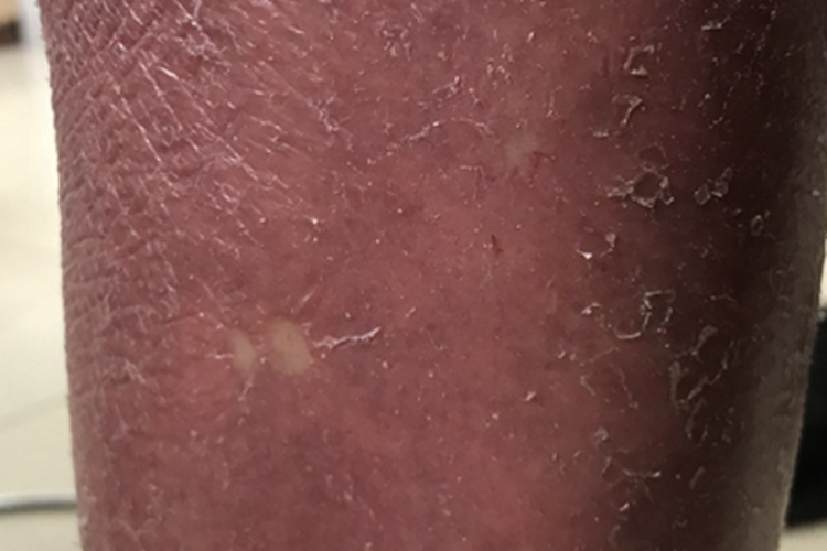 红皮病慢性期小腿脱屑图 红皮病慢性期小腿脱屑图
