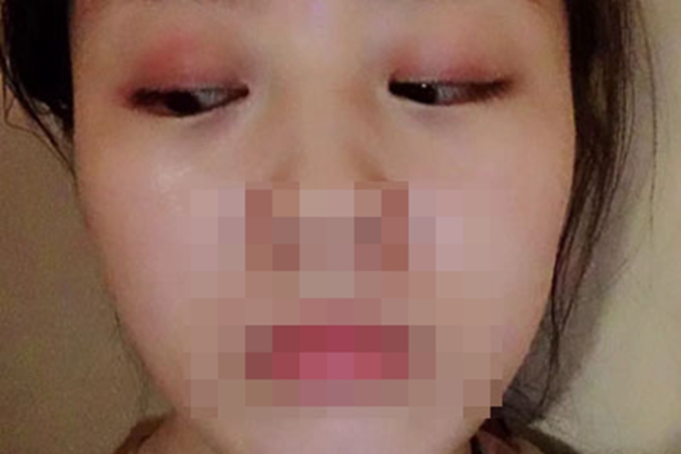 过敏性眼睑皮肤炎眼睑红肿图