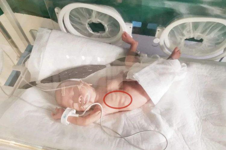 婴儿肺炎三凹症状图