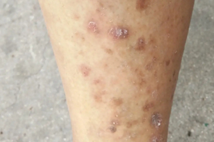 皮肤猪囊虫病小腿鳞屑图