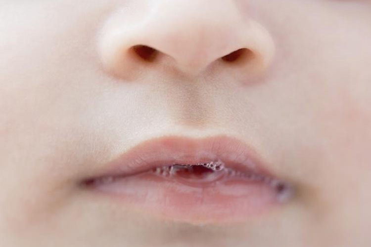 感染性肺炎婴儿吐泡泡图