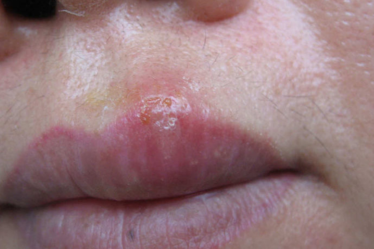 女性复发型单纯疱疹鼻周皮损图