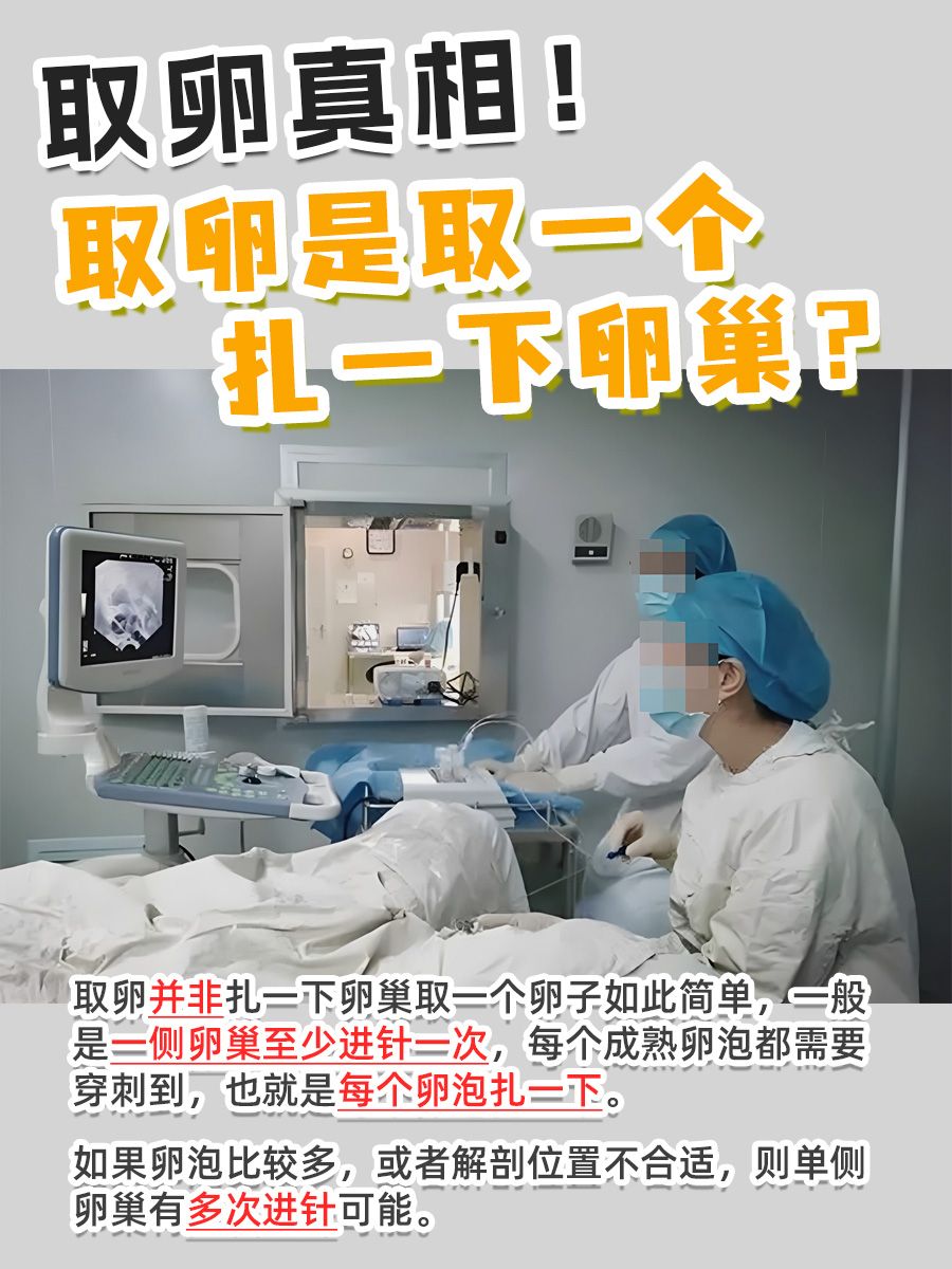 取卵真相！取卵是取一个扎一下卵巢？