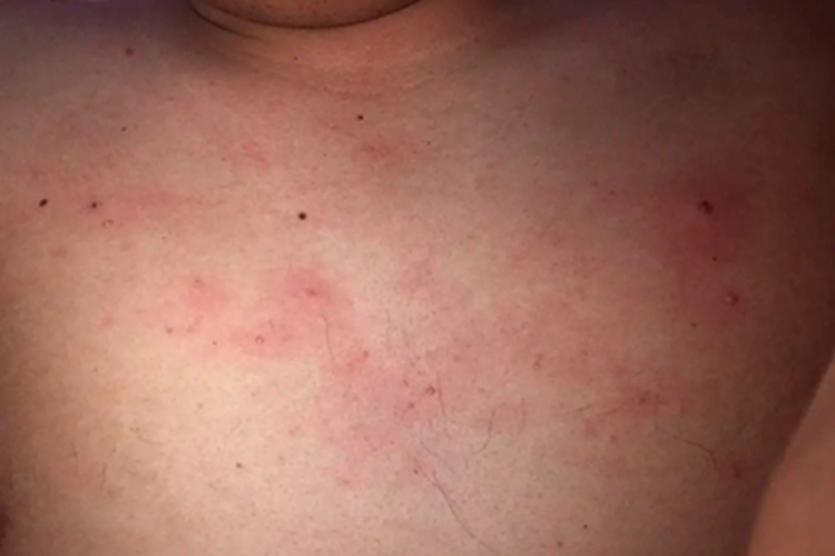 类癌综合征红点图 类癌综合征红点图