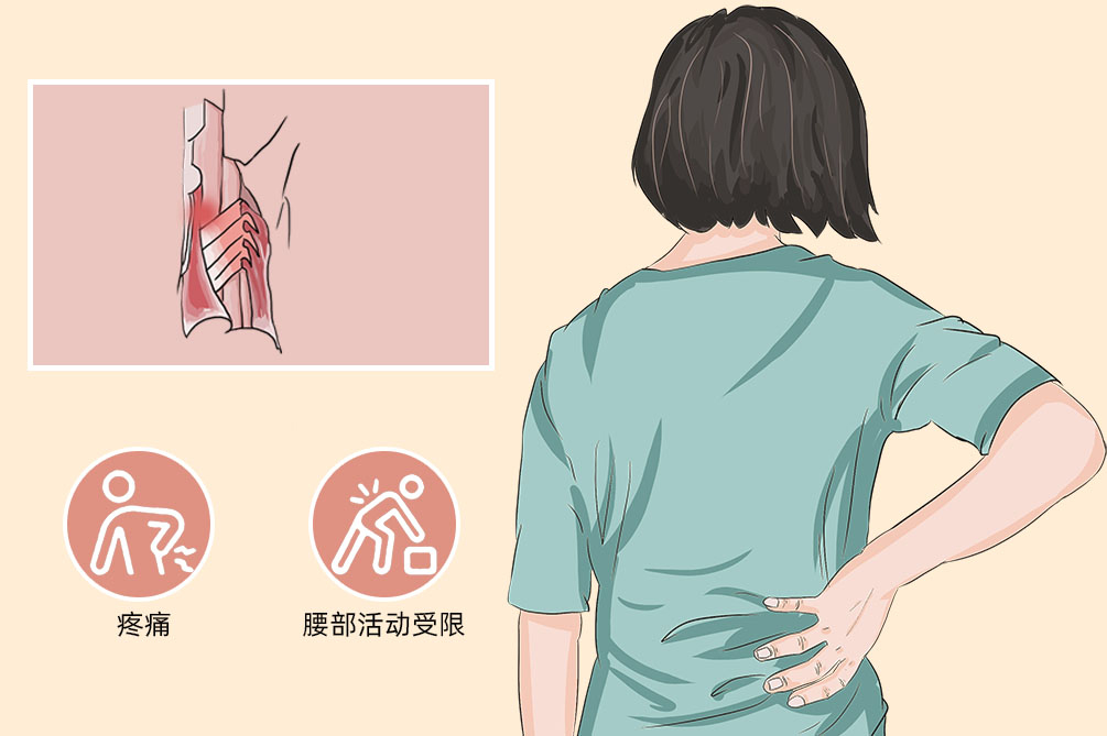 腰肌劳损图