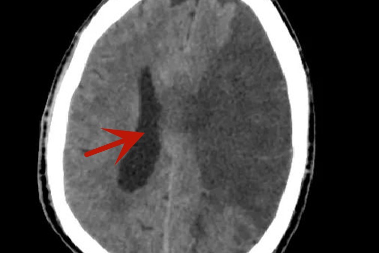 脑血栓CT影像图