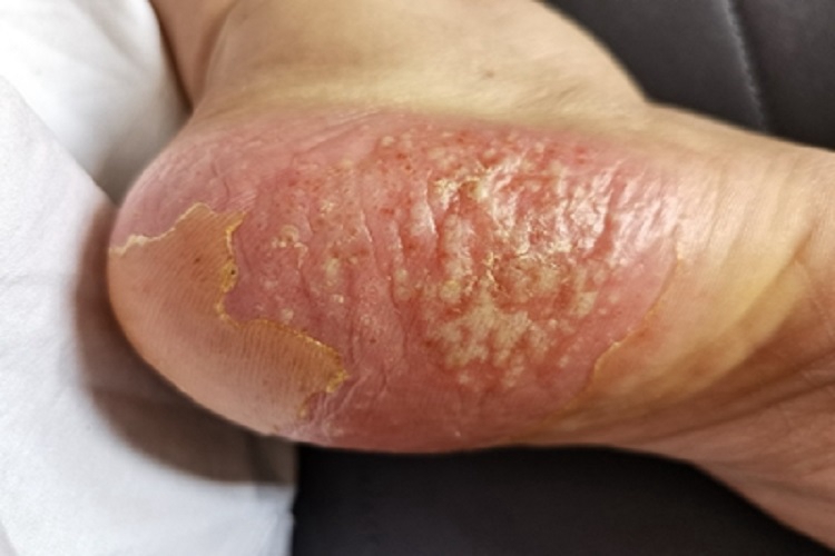汗疱疹脚底小水疱图