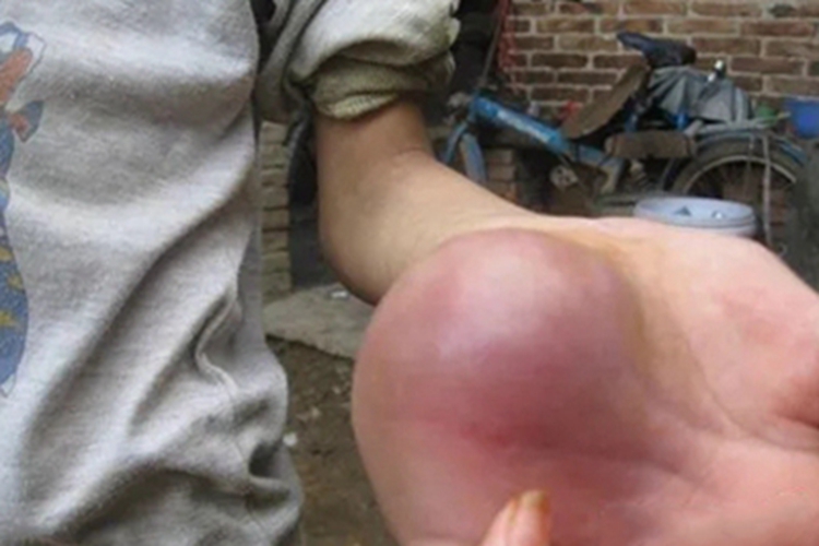 血友病A手部肿图 血友病A手部肿图