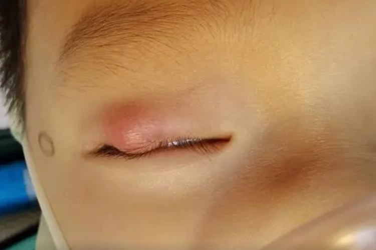 儿童眼长眼疖子图片大全
