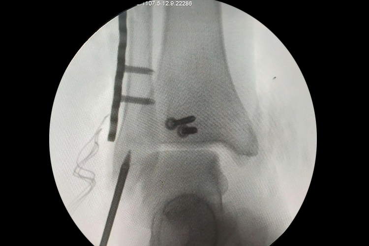 脚踝韧带手术铆钉影像图