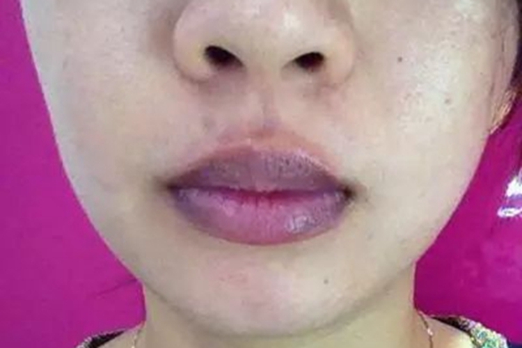 一氧化碳中毒嘴唇症状图