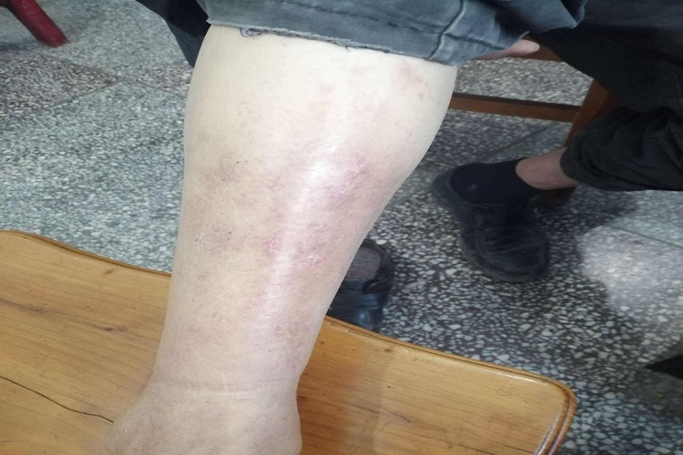 网状淋巴管炎图