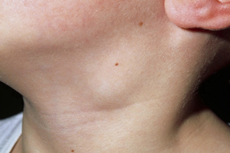 婴幼儿化脓性淋巴结炎右颈有包图