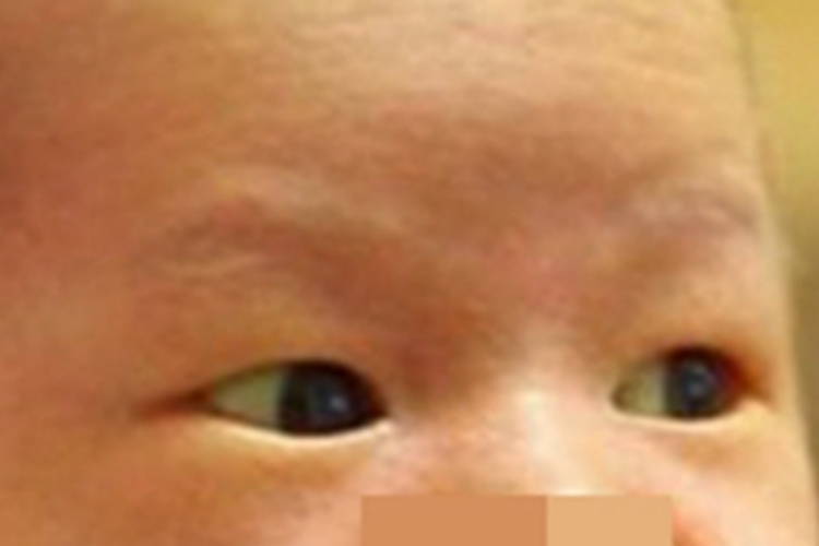 新生儿黄疸眼睛黄染图