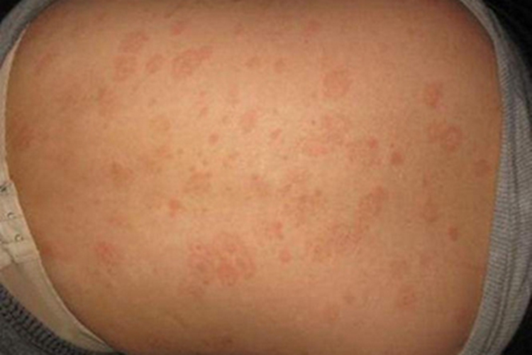 鹦鹉热背部症状图 鹦鹉热背部症状图