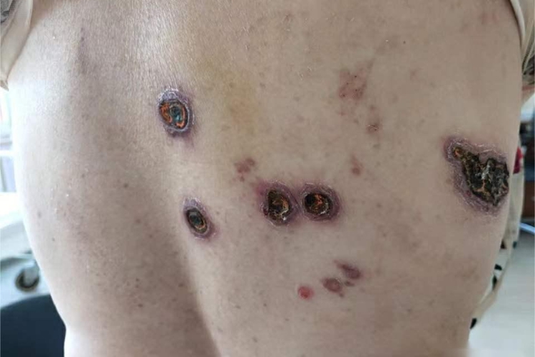脓疱型坏疽性脓皮病结痂图 脓疱型坏疽性脓皮病结痂图