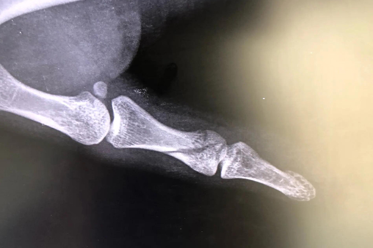 大拇指轻微骨裂影像图