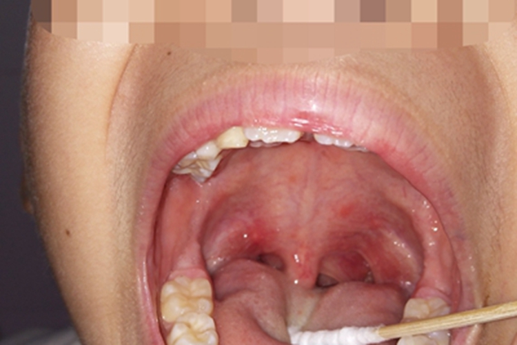 咽峡炎咽峡红肿图