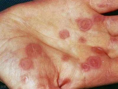红斑型天疱疮早期图.jpg