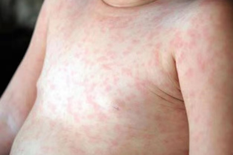 幼儿急疹图 幼儿急疹图